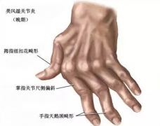手指处有这些症状 你可就要警惕类风湿发作了