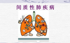 类风湿并发间质性肺病预后差要多加防范 成都治疗类风
