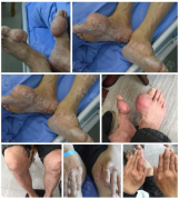 痛风风湿骨病患者注意：本周