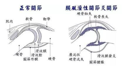 类风湿治疗