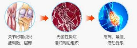 类风湿治疗