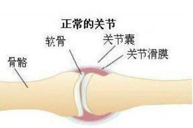 类风湿关节炎