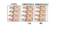 强直患者，你会选择医院吗？