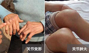 成都西部痛风风湿医院