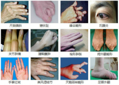 类风湿可能会让你致残，不可小看