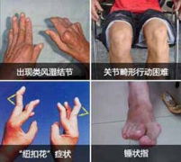  360度解析：类风湿的典型症状 