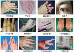 科学聚焦：类风湿性关节炎的治疗方法