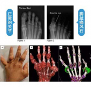  【警惕危害】痛风有哪些危害?并发症严重吗? 