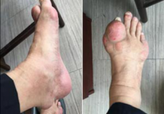 成都哪家医院治疗痛风好?痛风
