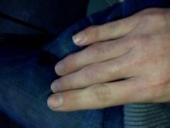 类风湿性关节炎疼吗?类风湿性关节炎的症状是什