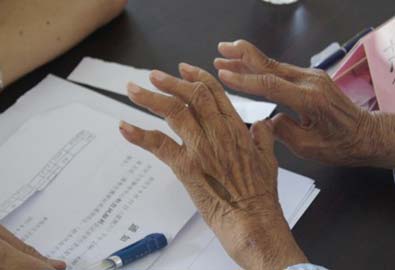 成都类风湿危害