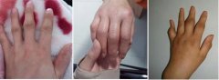 类风湿性关节炎治疗后如何护理