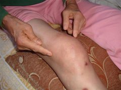 风湿性关节炎不治疗有什么危害吗
