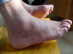 风湿性关节炎会遗传吗?