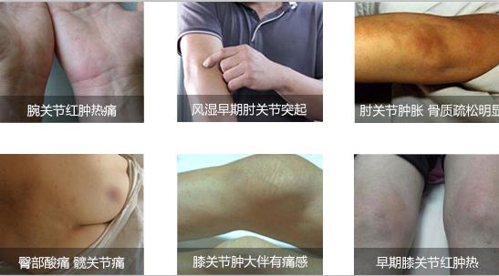 风湿关节炎症状