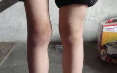 风湿性关节炎有哪些危害?风湿会致残吗?