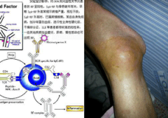关节僵硬对患者有什么影响?具体危害有哪些?