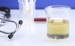 尿酸偏高是什么原因?如何控制尿酸升高?